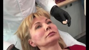 Коррекция филлерами скул и подбородка