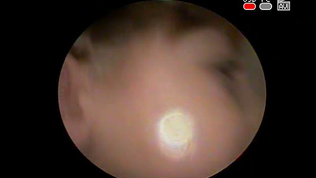 Острый гнойный средний #отит #Осложнение острого #ринита и аденоидита смотреть онлайн