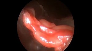 Эндоскопическая однопортальная декомпрессия локтевого нерва в кубитальном канале