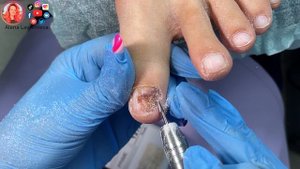 Протезирование ногтевой пластины / Три недели спустя