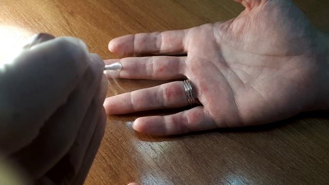 Криодеструкция бородавки на кисти рук