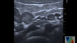 Л/у брыжейки