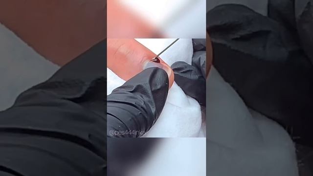 Гематома под ногтем смотреть онлайн