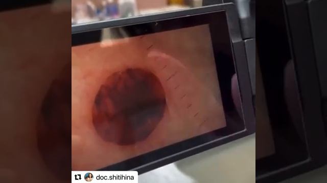 Удаление родинки смотреть онлайн