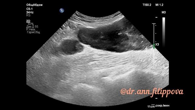 ПАРААОРТАЛЬНАЯ ЛИМФАДЕНОПАТИЯ на УЗИ ? Ultrasound Cases? PARAAORTAL LYMPHADENOPATHY on ultrasound ? смотреть онлайн