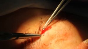 Удаление образования на верхнем веке. Профессор Орлов А.А.