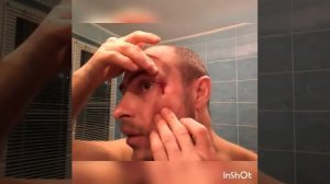 Как избавиться от фингала