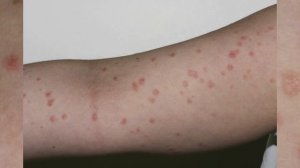 Каплевидный псориаз: фото начальной стадии, симптомы у детей и взрослых