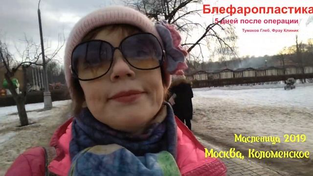 Блефаропластика нижних век. 5-ый день, ракурсы.