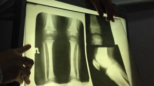 Рентген коленного сустава у ребенка