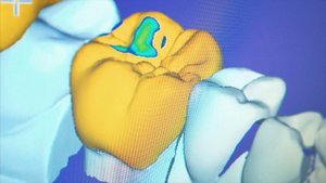 Циркониевые коронки в стоматологии "Эстетикс" в Москве