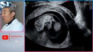 Conhecendo a gestação gemelar mono-mono!