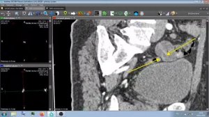 КТ АНГИОГРАФИЯ .