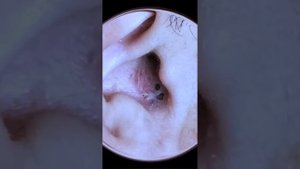 Ear Pimple and Blackhead Extraction: Cleaning Out Your Ears