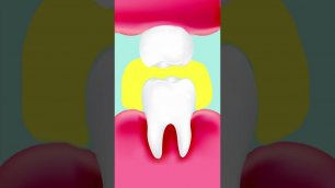 Как Убить Зубную Боль. Что делать если болит зуб? Как быстро избавиться от зубной боли?