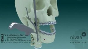 Остеотомия нижней челюсти