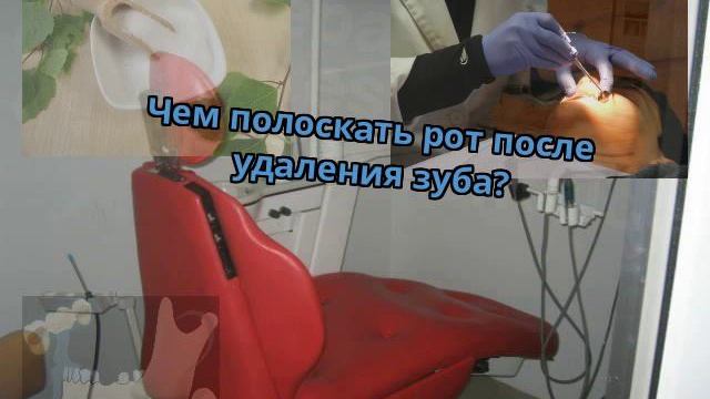 Чем полоскать рот после удаления зуба? смотреть онлайн