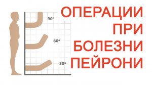 Операции при Болезни Пейрони