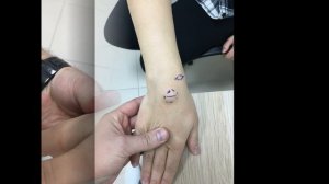Удаление гигромы кисти