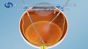 Лечение отслойки сетчатки  витрэктомия