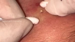 SUPER SATISFYING BLACKHEAD REMOVAL BY DR.LALIT KASANA