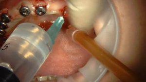 Установка формирователей десны