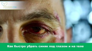 Как быстро убрать синяк под глазом и на теле в домашних условиях