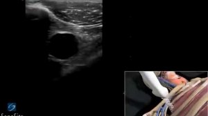 Катетеризация подключичной вены под контролем ультразвука