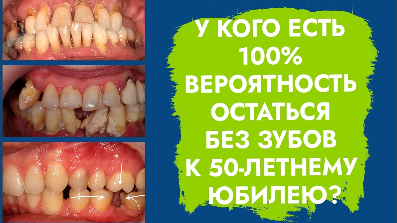 Отсутствие зубов. Кому грозит ранняя потеря всех зубов?