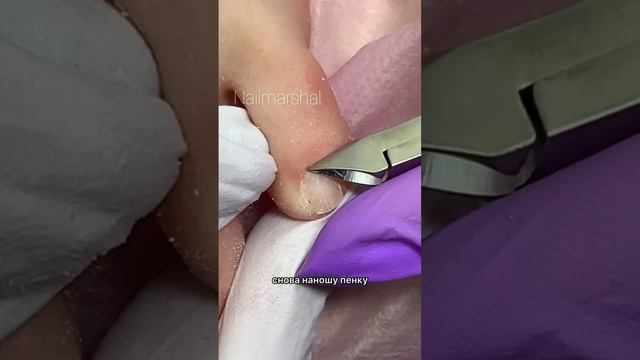 Обработка мизинца #педикюр #аппаратныйпедикюр #pinkroyss #мизинцы