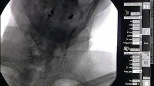 Стентирование левой внутренней сонной артерии при окклюзии правой внутренней сонной артерии