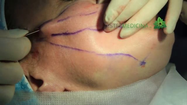 Установка нитей Силуэт Лифт ?  Silhouette Lift ✔️  НИТИ ДЛЯ ПОДТЯЖКИ ЛИЦА