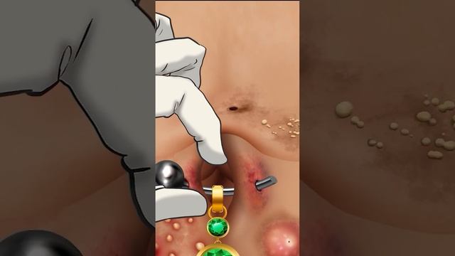 How to treat an infected and pus-filled navel piercing? Episode 1