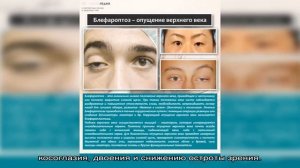 Исправление птоза верхнего века