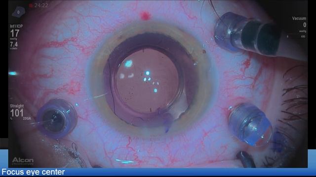 Synthesis Toric , PPV for ERM peeling Lukan Mishev Live Stream смотреть онлайн