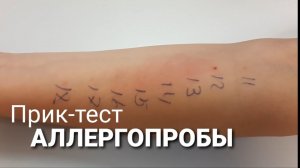 Аллергопробы | Прик-тест