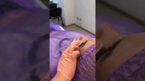 Коррекция скул/контурная пластика/филлеры/разметка лица по Хиндереру