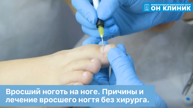 Вросший ноготь на ноге. Причины и лечение вросшего ногтя без хирурга.