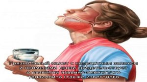 Как снять белый налет с миндалин при ангине