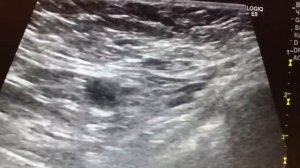 Метастаз лимфоузел