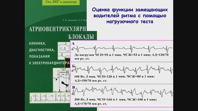 Доклад к.м.н. Т.В. Трешкур на конференции "Желудочковые нарушения ритма сердца". смотреть онлайн