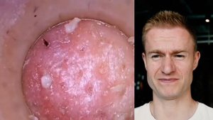 СТРАШНЫЕ ПРОБЛЕМЫ С КОЖЕЙ: черные точки, выдавливание прыщей и другое