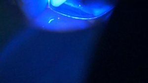 Кариес под микроскопом 2017 \ caries treatment under microscope