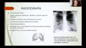 Neumonitis interticial difusa y neumoconiosis