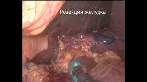 Лапароскопическая дистальная субтотальная резекция желудка с лимфодиссекцией D2
