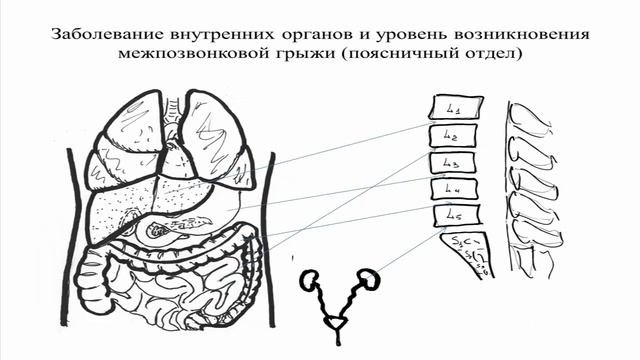 ПОЧЕМУ ВОЗНИКАЮТ МЕЖПОЗВОНКОВЫЕ ГРЫЖИ