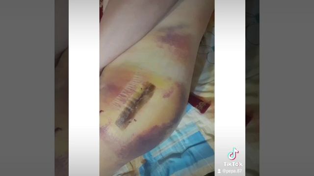 эндопротезирование тазобедренного  сустава.