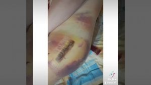 эндопротезирование тазобедренного сустава.