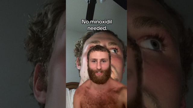 Did I use Minoxidil to grow my Beard?