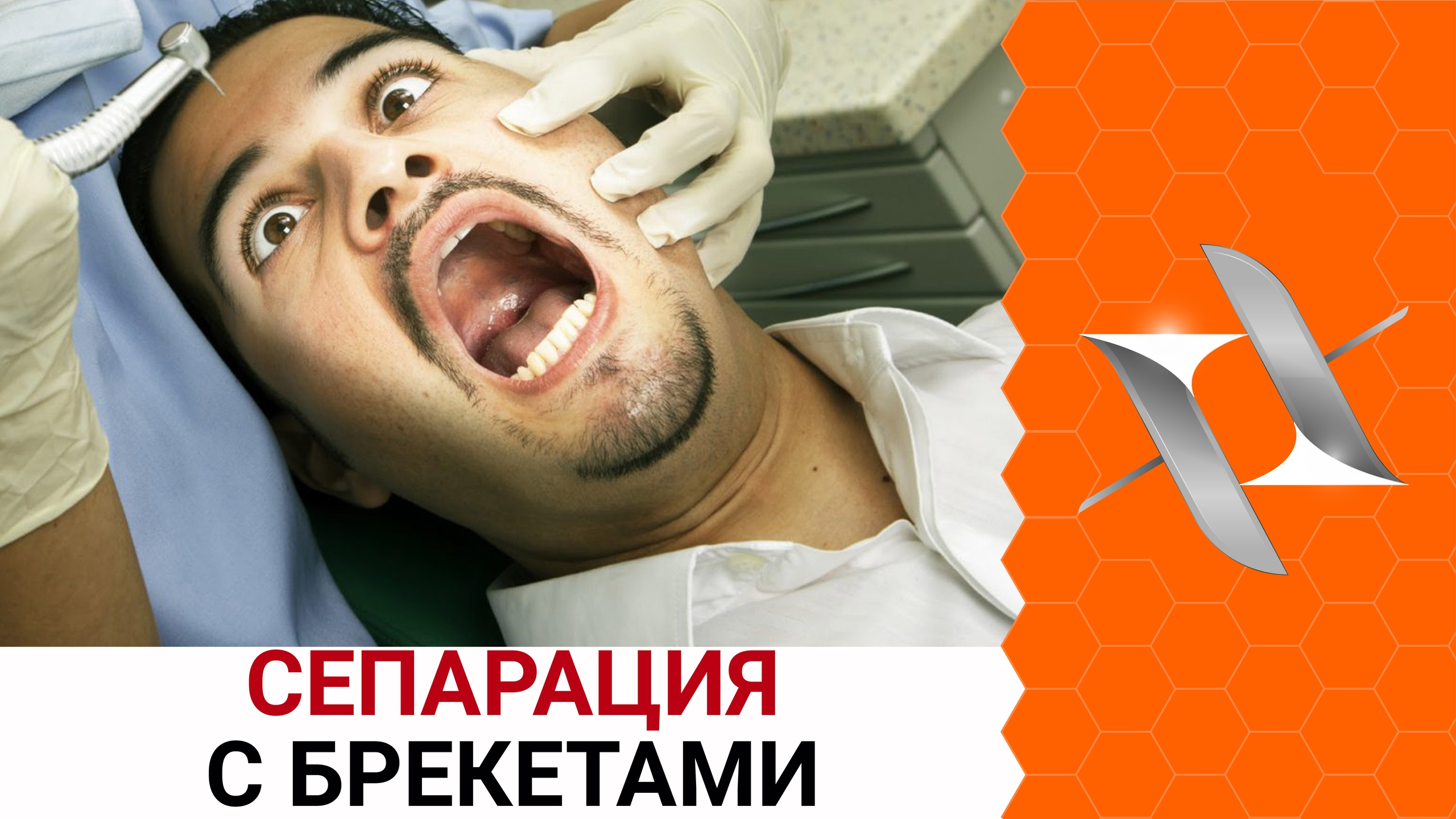 БРЕКЕТЫ. СЕПАРАЦИЯ. Главный страх пациентов.